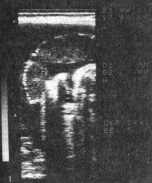 Рис. 1. Плацента при физиологической беременности близко к сроку родов; толщина 3,5 см; эхопозитивные участки в области базальной пластинки (кальциноз)