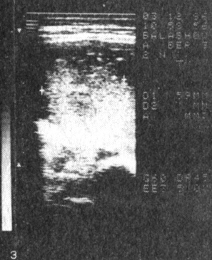 Рис. 3. Плацента (I тип) при беременности 32 нед, осложненной преэклампсией; расположена в области правого трубного угла матки; толщина 5,9 см