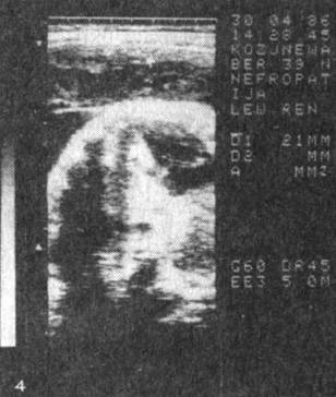 Рис. 4. Плацента (II тип) при беременности 39 нед, осложненной нетяжелой формой позднего токсикоза (гипоплазия); толщина 2,1 см; эхонегативный участок в толще ткани (кровоизлияние) и эхопозитивные включения (кальциноз) в области базальной пластинки
