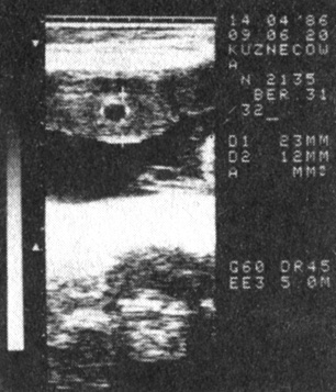 Рис. 5. Плацента (II тип) при беременности 31 нед, осложненной преэклампсией (гипоплазия); толщина 2,3 мм; эхонегативный участок в толще ткани (кровоизлияние)