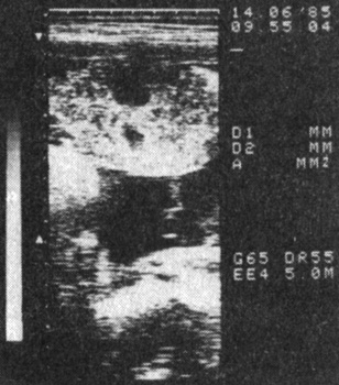 Рис. 8. Плацента (III тип) при беременности 39 нед, осложненной преэклампсией; эхонегативный участок вблизи от базальной пластинки. Высокий риск преждевременной отслойки плаценты